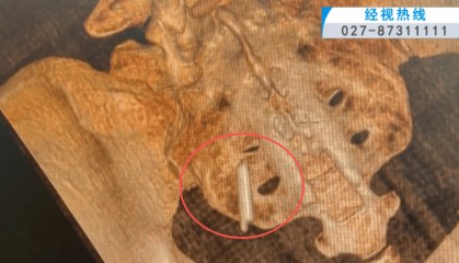 体温表在体内断裂，女子时隔22年彻底取出！医生：庆幸水银不在里面