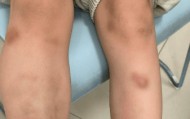 吃生菜包烤肉后满身瘀斑，“元凶”竟是它